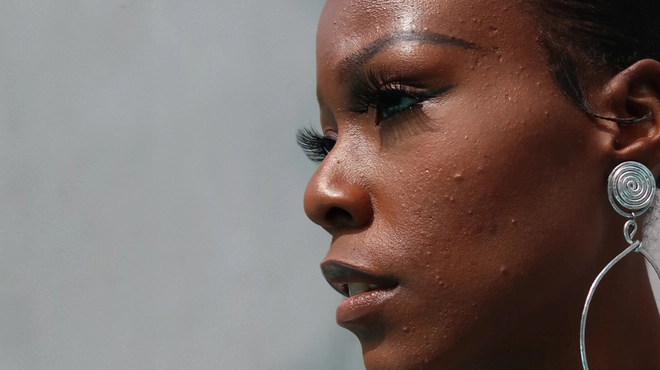 A portrait of Jasmine, an hidradenitis suppurativa (HS) advocate, journalist and filmmaker